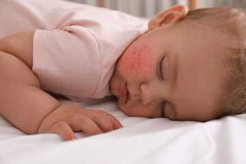 Cute little baby with allergic redness sleeping on bed, closeup