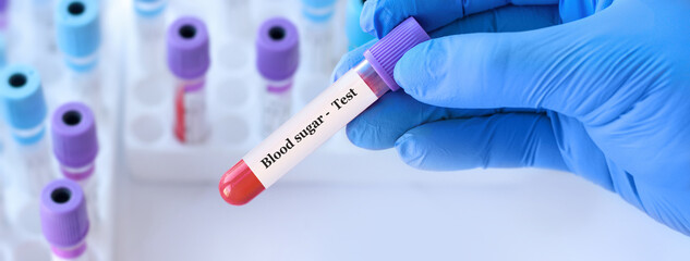 Doctor holding a test blood sample tube with Sugar test on the background of medical test tubes with analyzes.Copy space for text - obrazy, fototapety, plakaty