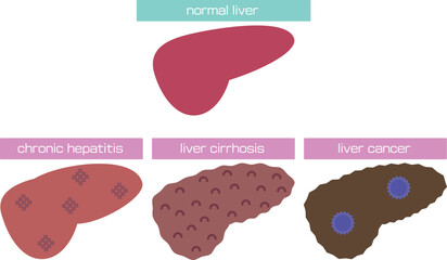 慢性肝炎から肝癌までを表したイラスト／Illustration showing from chronic hepatitis to liver cancer