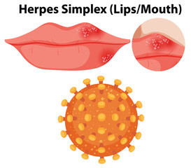 Herpes simplex virus (Lips/Mouth)