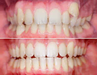 Complete smile makeover from crooked teeth to well aligned smile. Before/after after using aligners...