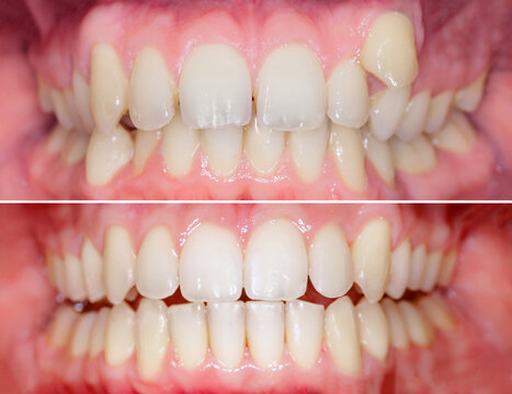 Complete smile makeover from crooked teeth to well aligned smile. Before/after after using aligners invisalign or brackets