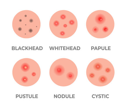 Types of acne illustration. Pimples, skin pores, blackhead, whitehead, scar, comedone. Skincare problems and inflammation. Acne skin types