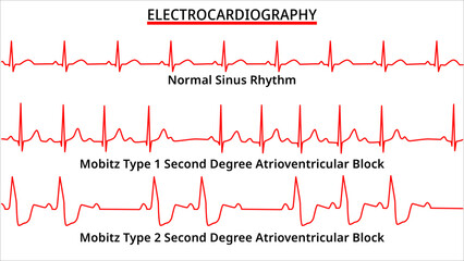 Set of ECG Common Abnormalities - Normal Sinus Rhythm - Mobitz Type 1 and 2 - Second Degree Atrioventricular (AV) Block - Electrocardiography - Vector Medical Illustration