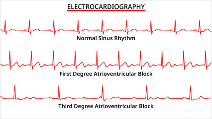 Set of ECG Common Abnormalities - Normal Sinus Rhythm - First and Third Degree Atrioventricular (AV) Block - Electrocardiography Vector Medical Illustration