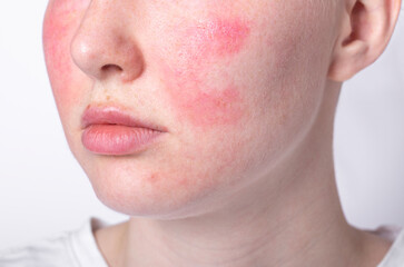 rosacea couperose redness skin, red spots on cheeks, young woman with sensitive skin, patient face close-up  - obrazy, fototapety, plakaty