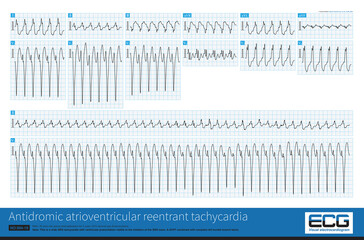 Atrioventricular accessory pathway is a cause of wide QRS tachycardia, and sometimes it is difficult to distinguish it from ventricular tachycardia, unless the ventricular preexcitation are typical.