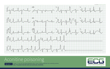 In aconitine poisoning, the atrium is inhibited, the amplitude of P wave decreases or atrial fibrillation occurs; ventricular triggering activity increased and ventricular arrhythmia occurred.