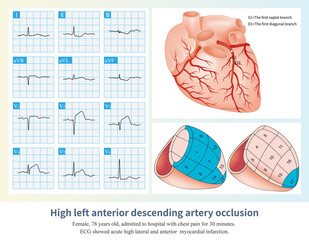 When the occlusion of the LAD is located in the common trunk above the opening of the first septal branch and the first diagonal branch, a large area of left ventricular infarction is caused.