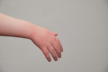 The child scratches atopic skin. Dermatitis, diathesis, allergy on the child's body.irritation and...