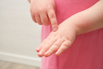 The child scratches atopic skin. Dermatitis, diathesis, allergy on the child's body.irritation and pruritus.