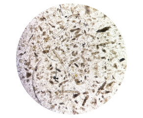 Microscopic urine examination showing Granular cast, a sign of many types of kidney diseases.