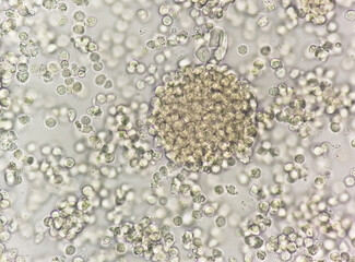 Pyuria or leukocyturia is the condition of urine containing white blood cells or pus. It can be a sign of a bacterial urinary tract infection