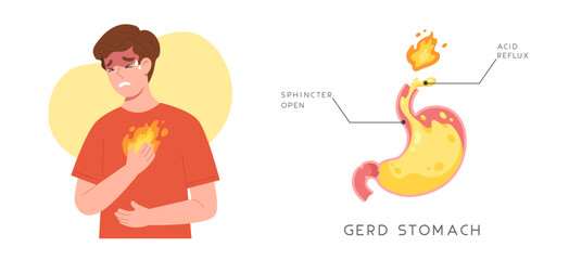 Man suffering from GERD symptom with acid reflux because of sphincter opened stomach. 
Gastroesophageal reflux disease. Heartburn. Digestive system disease. Flat vector illustration.