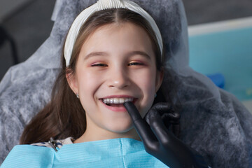 caucasian little kid girl invisible aligner and pointing to her perfect straight teeth. Dental...