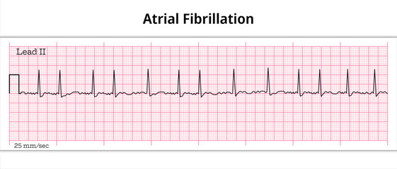 ECG Atrial Fibrillation - 8 Second ECG Paper - Electrocardiography Vector Medical Illustration