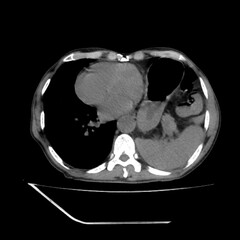 Diaphragm hernia chest ct scan
