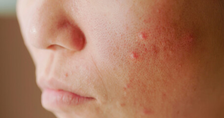 woman acne problem on face