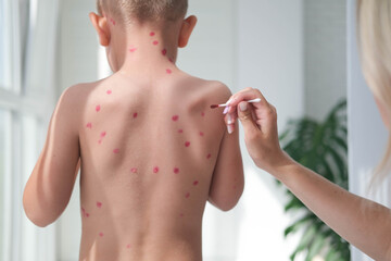 Treatment of ulcers from chickenpox, varicella with medical cream on the kid skin. Mom treats the...