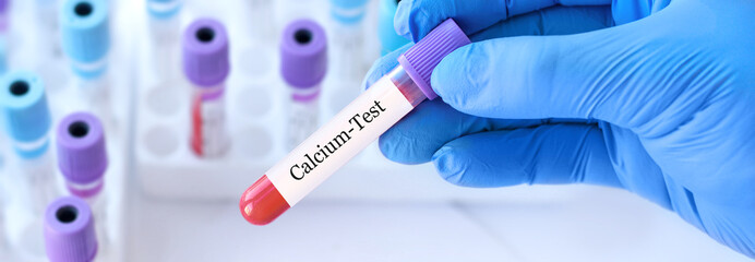 Fototapeta premium Doctor holding a test blood sample tube with calcium test on the background of medical test tubes with analyzes.