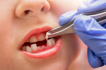 Removal of a milk tooth. The doctor pulled out a tooth from a child with tweezers. Extraction of a...