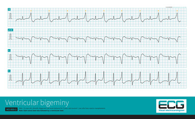 A 14-year-old leukemic child had a sudden wide QRS tachycardia with a frequency of 167 bpm, and the rhythm was regular. After anti-arrhythmia treatment, the patient recovered to ventricular bigeminy.