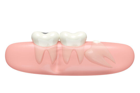 3d wisdom teeth model problems icon with gums isolated. dental examination of the dentist, health of white teeth, oral care, 3d render illustration