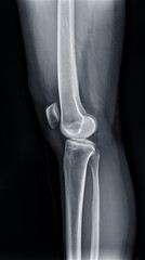 Film x-ray  of Left knee joint  Lateral  view  for diagnosis knee pain from osteoarthritis knee ...