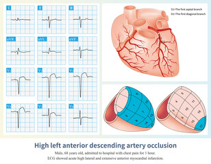 When the occlusion of the LAD is located in the common trunk above the opening of the first septal branch and the first diagonal branch, a large area of left ventricular infarction is caused.