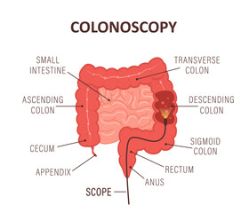 Colonoscopy concept. Intestine exam and treatment. Bowel polypectomy procedure. Anatomy of colon. Prevention of cancer. Vector illustration in flat cartoon style. - obrazy, fototapety, plakaty