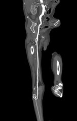 CTA femoral artery run  off MPR curve  showing Right  femoral artery for diagnostic  Acute or...