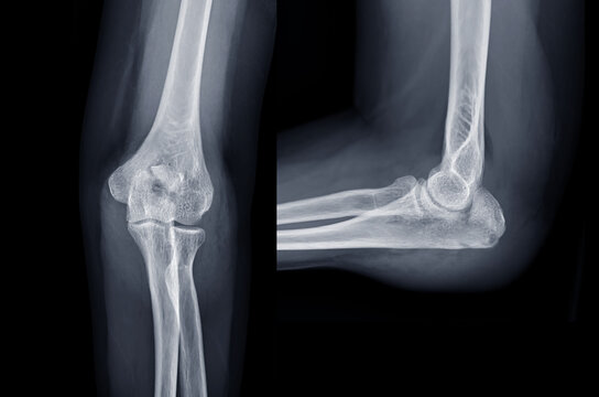 X-ray of Elbow join showing  fracture of ulna bone.