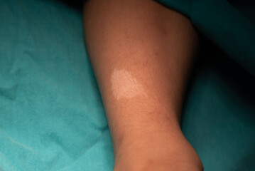 Hypomelanic macules on the leg in tuberous sclerosis patient.