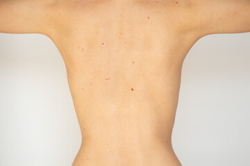 The back of a young thin girl on a white background without retouching and processing, medicine and body