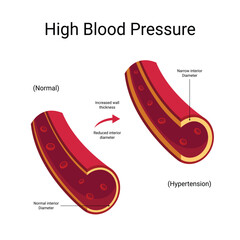 High blood pressure vector illustration, hypertension infographic