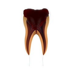 Tooth caries stages, development of teeth decay with enamel and dentin caries pulpitis and periodontitis. Medical dentist concept. Realistic 3D file PNG.
