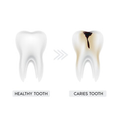 Tooth caries stages, development of teeth decay with enamel and dentin caries pulpitis and periodontitis. Medical dentist concept. Realistic 3D file PNG.