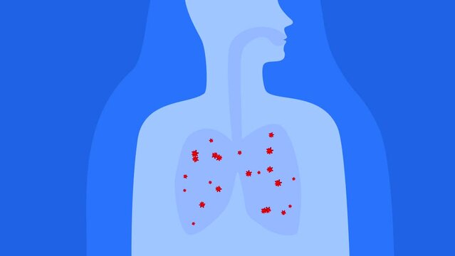 Animation of lung disease, or respiratory system, coronavirus. Bacteria in the lungs, illustration of the course of the disease