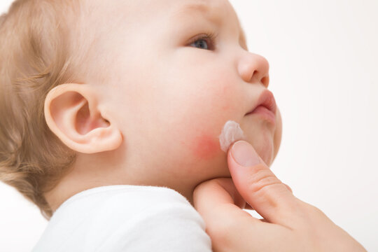 Young adult mother finger applying white medical ointment on infant boy cheek on light gray background. Red rash on skin. Allergy from food, milk formula or mother milk. Care about baby body. Closeup.