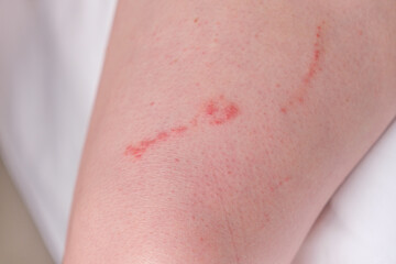 An allergic reaction on the skin from contact with a jellyfish © Galina