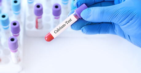 Doctor holding a test blood sample tube with calcium test on the background of medical test tubes...
