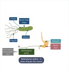 Helicobacter pylori is one of the most important causes of peptic ulcer