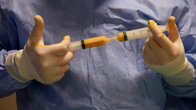 4K close-up preparation of liposuction fat for stem cell therapy during real time surgery. Filtration of fat by doctor. Stem cell generation from fat stock video.