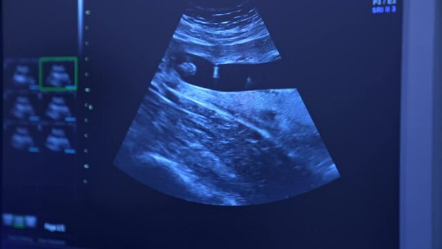Ultrasound image of in vitro fertilization. Close up. Modern hospital equipment for reproductive medicine.