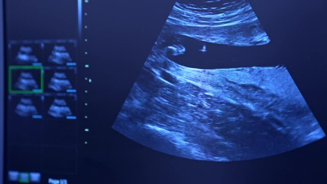 Screen of ultrasonic equipment showing the process of artificial extracorporeal fertilization in modern hospital. Close up.