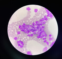 Immatture  wbc Acute lyphoblastic leukemia.