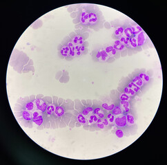 shift to the left neutrophil in smear CBC.