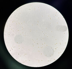 Squamous epithelial cell with rbc in Urine.