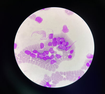 Immatture  wbc Acute lyphoblastic leukemia.