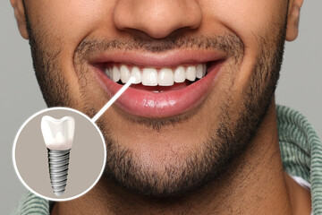 Happy man with perfect teeth smiling on grey background, closeup. Illustration of dental implant - obrazy, fototapety, plakaty